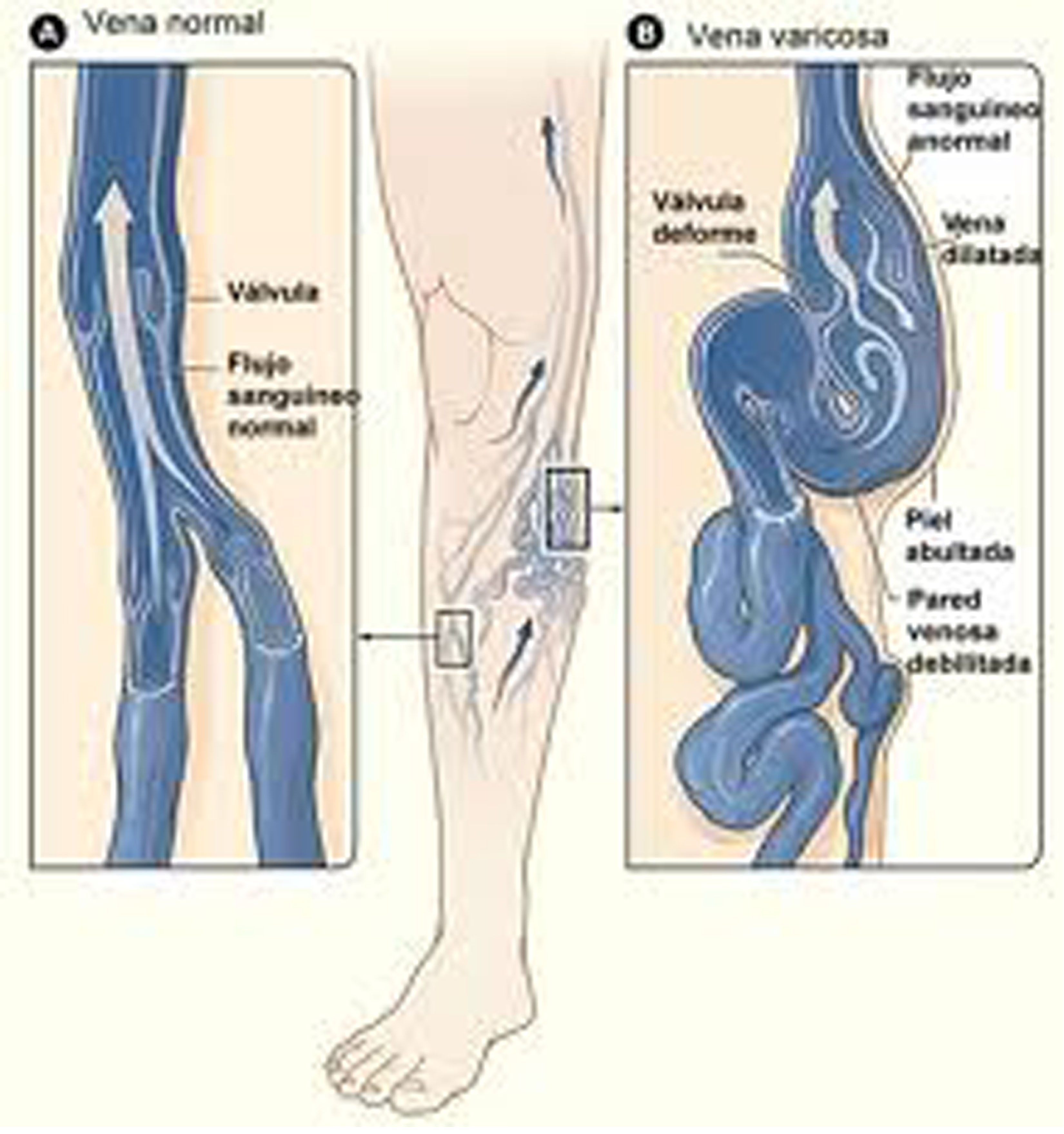 venele de post i varicoza edema picioare cu varicoza